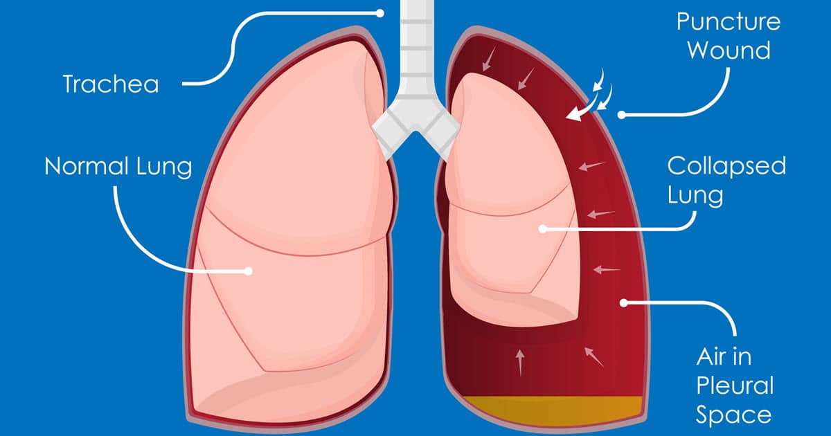 Acute Respiratory Distress Syndrome (ARDS) & Blunt Force Trauma